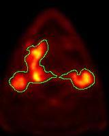 Contouring Challenge at the XII Turku PET Symposium
