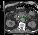 CT_aorta.png